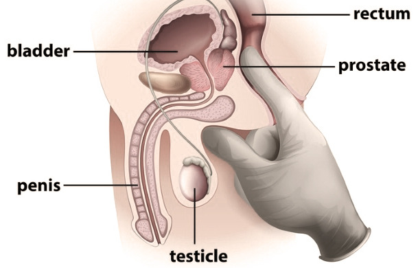symptom prostate cancer,pristate massage,postrate gland