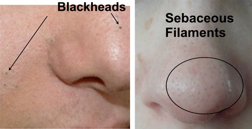 Image result for sebaceous filaments blackheads