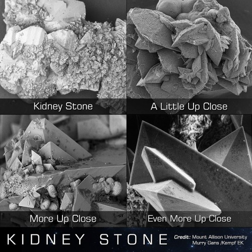 sixpenceee:

A kidney stone magnified. Yikes! (Source)
