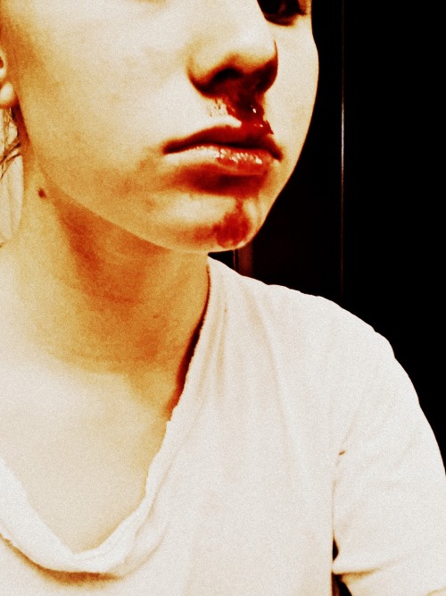 imohpositive:

I got a massive bloody nose on Friday
This is after it stopped dripping blood everywhere