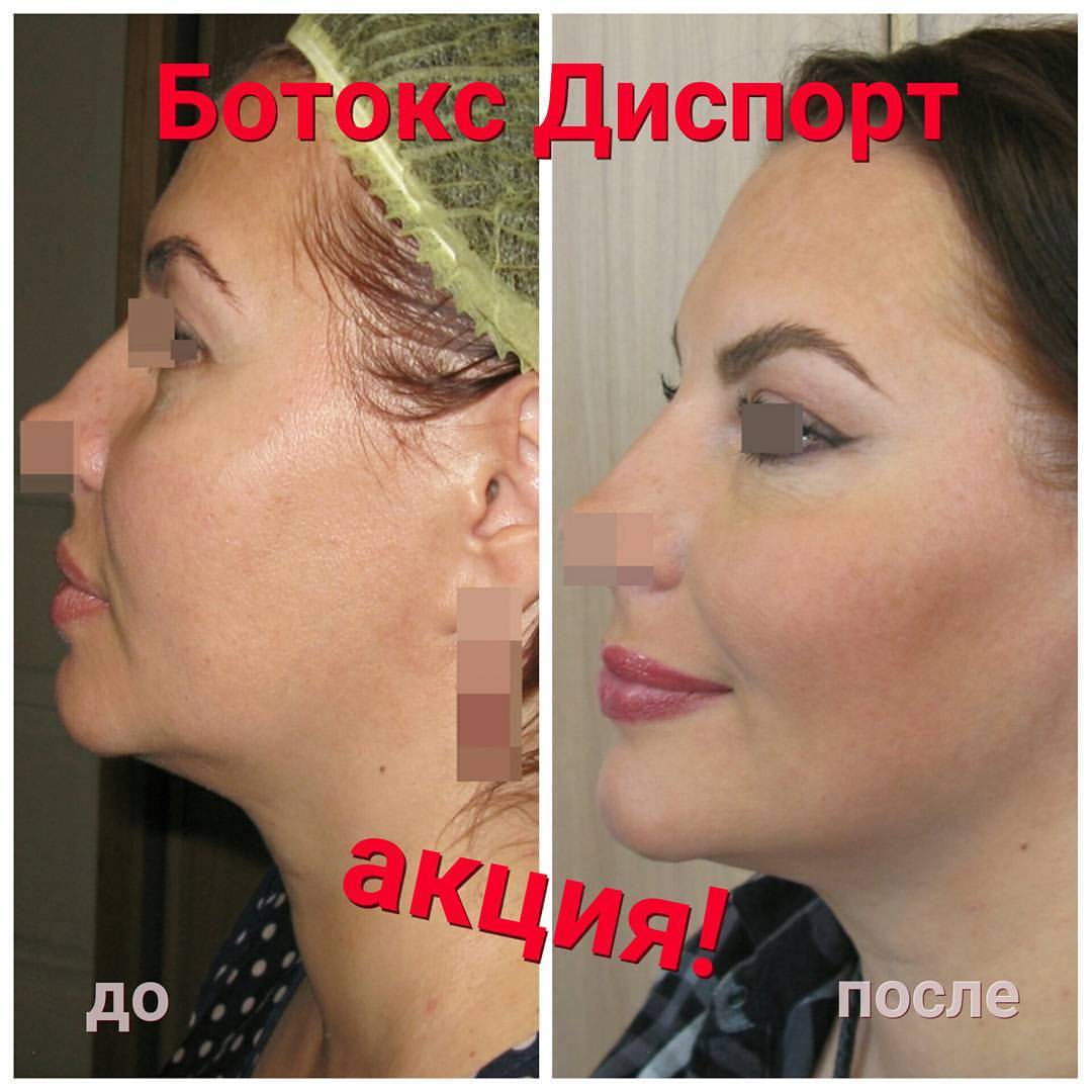 Ботокс для коррекции овала лица Ботокс для коррекции овала лица