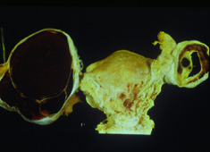 Danazol Endometriosis Usmle