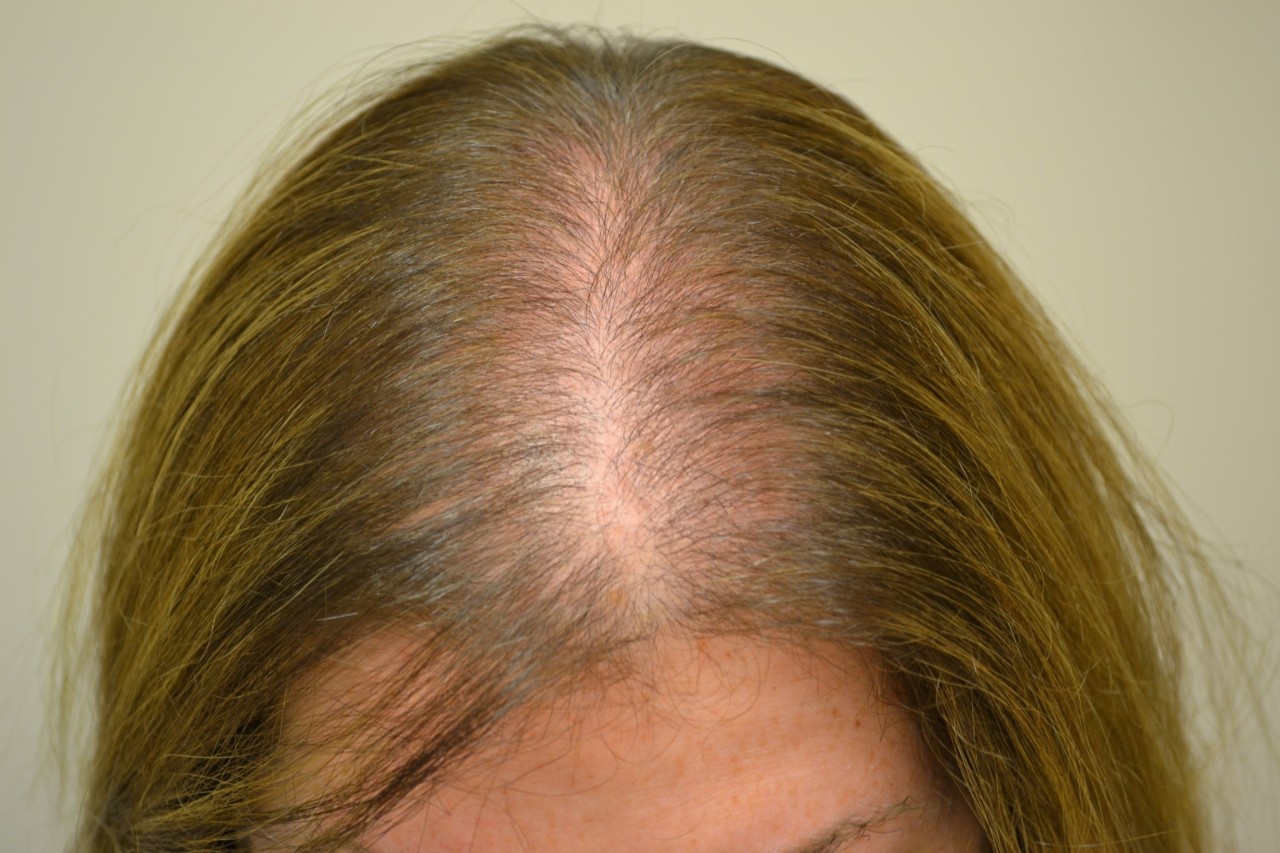 5 Natural Treatment For Hair Loss Due To Alopecia