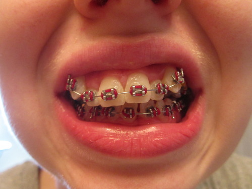 I had an appointment with the orthodontist today....