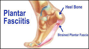 <p><b>
Treating Plantar Fasciitis</b></p><p>The plantar fascia is the thick band of tissue that makes up the arch of the foot by connecting the heel bone to the toes. When this band becomes overused and stretched, it becomes inflamed. This inflammation is referred to as plantar fasciitis and results in pain. </p><p>Several conservative treatment options exist. </p><p><b>Rest</b>: if possible, rest the area and avoid overuse.</p><p><b>Proper Footwear</b>: Since the plantar fascia makes up the arch of the foot, supporting this arch will keep the plantar fascia from overstretching. A proper shoe has a secure closure such as lace or hook and loop, and maintains the arch and a normal alignment of the foot. If plantar fasciitis is a result of poor foot biomechanics, such as fallen arches or excessively high arches, over the counter or custom made insoles may also be necessary to maintain proper foot alignment. Many patients find that wearing shoes with a heel lift or a higher heel helps alleviate pain of the plantar fascia. Higher heeled shoes place the calf muscle on slack, so the plantar fascia is not being pulled</p><p><b>Stretching Exercises</b>: Stretching the heel and calf muscle is very important. Tight calf muscles can lead to an overstretched plantar fascia. Exercises may include reaching for the toes with straight legs, or wall lunges with a straight back leg while the foot remains flat on the floor.</p><p><b>Cold Therapy</b>: During the first few days of plantar fasciitis, this injury will respond well to cold therapy. Applying<a href="http://lifeandlimbgel.com/"> ice packs </a>or <a href="http://lifeandlimbgel.com/products">cold therapy</a> to the affected area for 10-15 minutes will decrease the swelling. Ice treatments should focus at the source of pain, usually at the heel where the plantar fascia inserts.</p><p><b>Anti-inflammatory medications</b>: Ibuprofen or Naproxen can decrease the inflammation in the tissues.</p><p>Other treatment measures may include: </p><p><b>Lifting The Heel</b>: Wearing a heel cup, shoe lifts under the heel, or a higher heeled shoe places the plantar fascia in a position to protect from over-stretching. Lifting the heel may help the condition, but it is not a permanent fix. Stretching tight calf muscles to increase the flexibility of the heel will be a more permanent fix. If stretching doesn’t work, custom orthotics may be a next step.<br/><br/><b>Night Splints</b>: When this condition persists, night splints can help to stretch the calf muscle and heel. Night splints place the calf on stretch by lifting the toes and preventing plantar flexion (a pointed toe position).</p><p><b>Boot Cast/Walking Boot</b>: Occasionally patients will revert to a removable walking boot for several weeks.</p><p><b>Injections</b>: Instances occur where patients need more aggressive approaches to treating this condition. Steroid injections to the plantar fascia may be beneficial in these instances.</p><p><b>Surgical Release</b>: When conservative methods fail, surgery to release the plantar fascia are often a last resort. </p><p>Conservative treatment methods are usually effective, but it can take several months to fully recover. After recovering from Plantar Fasciitis, many patients will suffer recurrence. If the patient continues the conservative treatment plan as a preventative measure, this condition is much less likely to reoccur. Maintaining flexibility in the ankle, stretching the heel and calf muscle (preferably in the morning before getting out of bed), wearing proper footwear, maintaining a healthy body weight, and avoiding overuse are great methods of preventing this condition. </p>