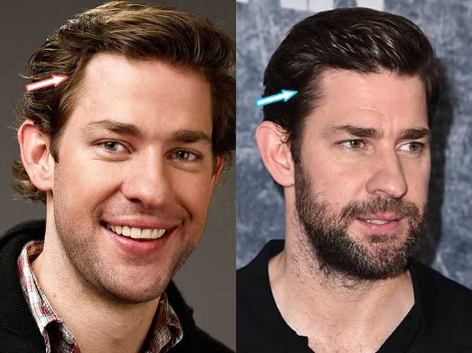 Draw And Celeb John Krasinski Cosmetic And Plastic Surgery