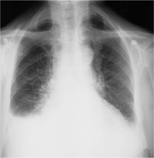 Radiology: Common Chest Pathologies - Adventures of a PA-C