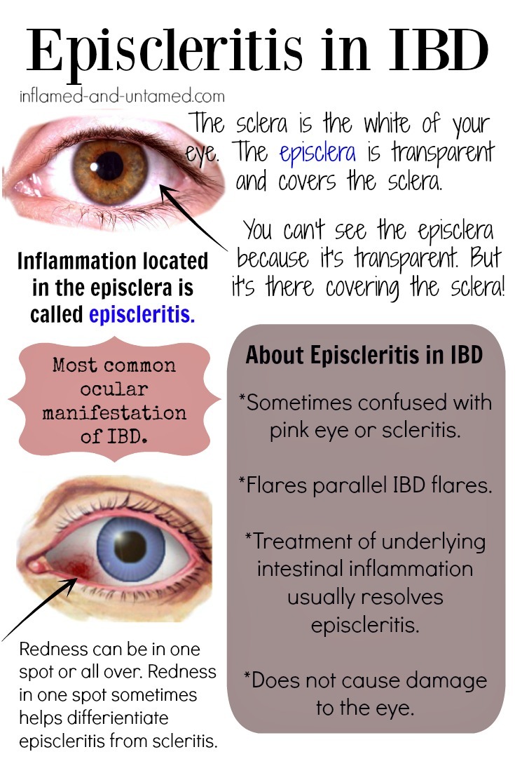 Eye Complications in Crohn’s Disease and... Inflamed and