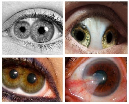 polycoria double pupil eye polycoria double pupil eye