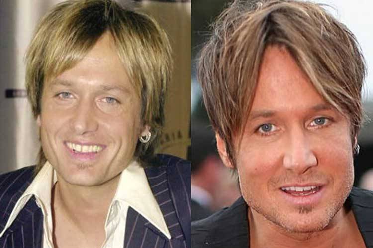 Before And After Keith Urban Plastic Surgery