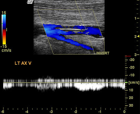 What is a Venous Doppler, When should you order... - The US Diagnostics ...