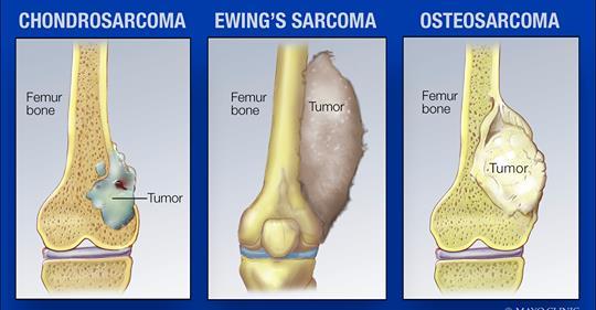 primary-malignant-melanoma-of-left-lower-lobe-of-lung-a-case-report