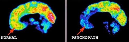 luciferlaughs:The brain scan showing normal brain activity...