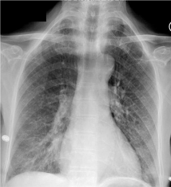 Radiology: Common Chest Pathologies - Adventures of a PA-C