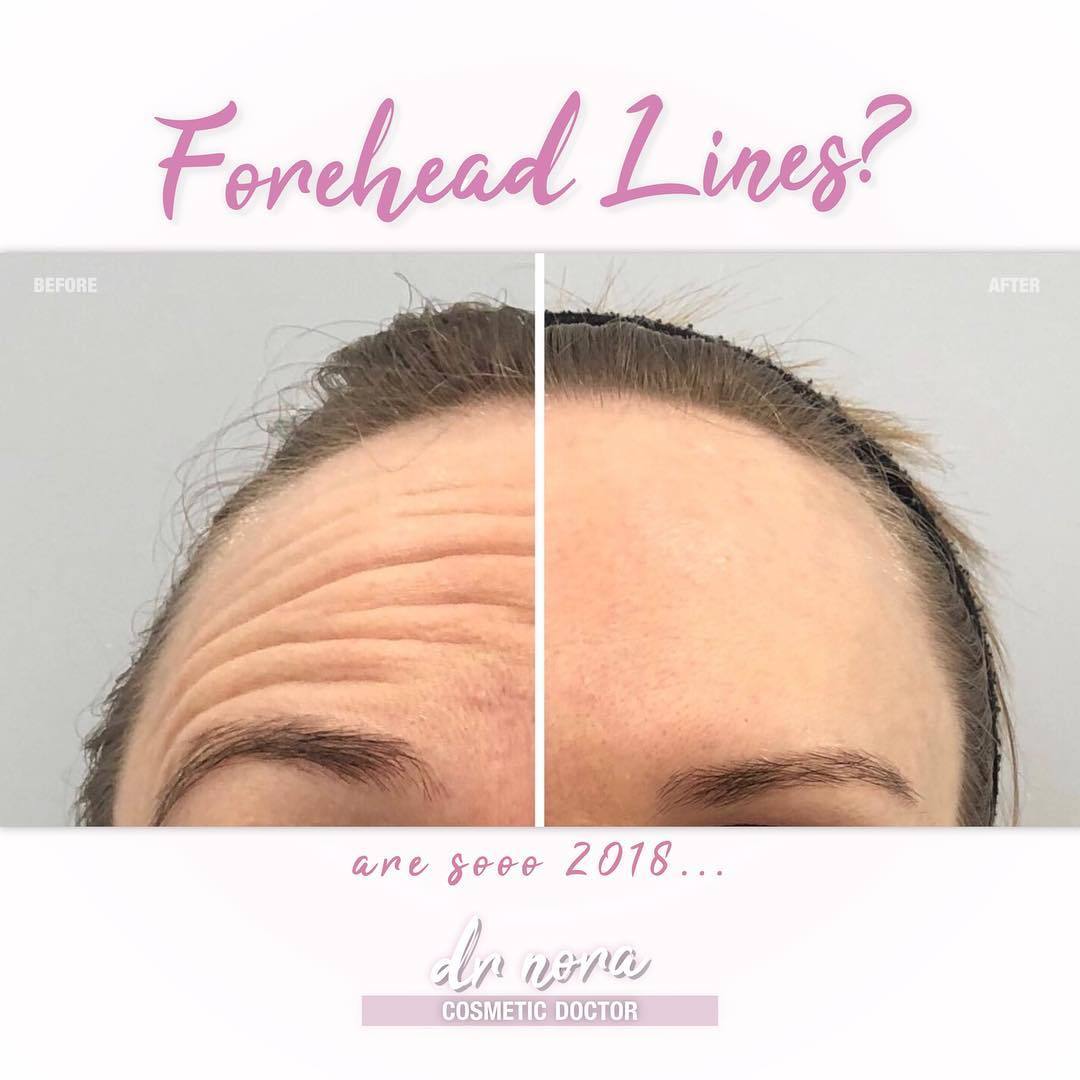 Forehead lines are so last year πIs exactly what this gorgeous lady is saying as she heads into the new year with a smooth, wrinkle free face π
Anti-wrinkle therapy is quick and easy with optimal results at 2 weeks and treatment lasting 3-5 months,...