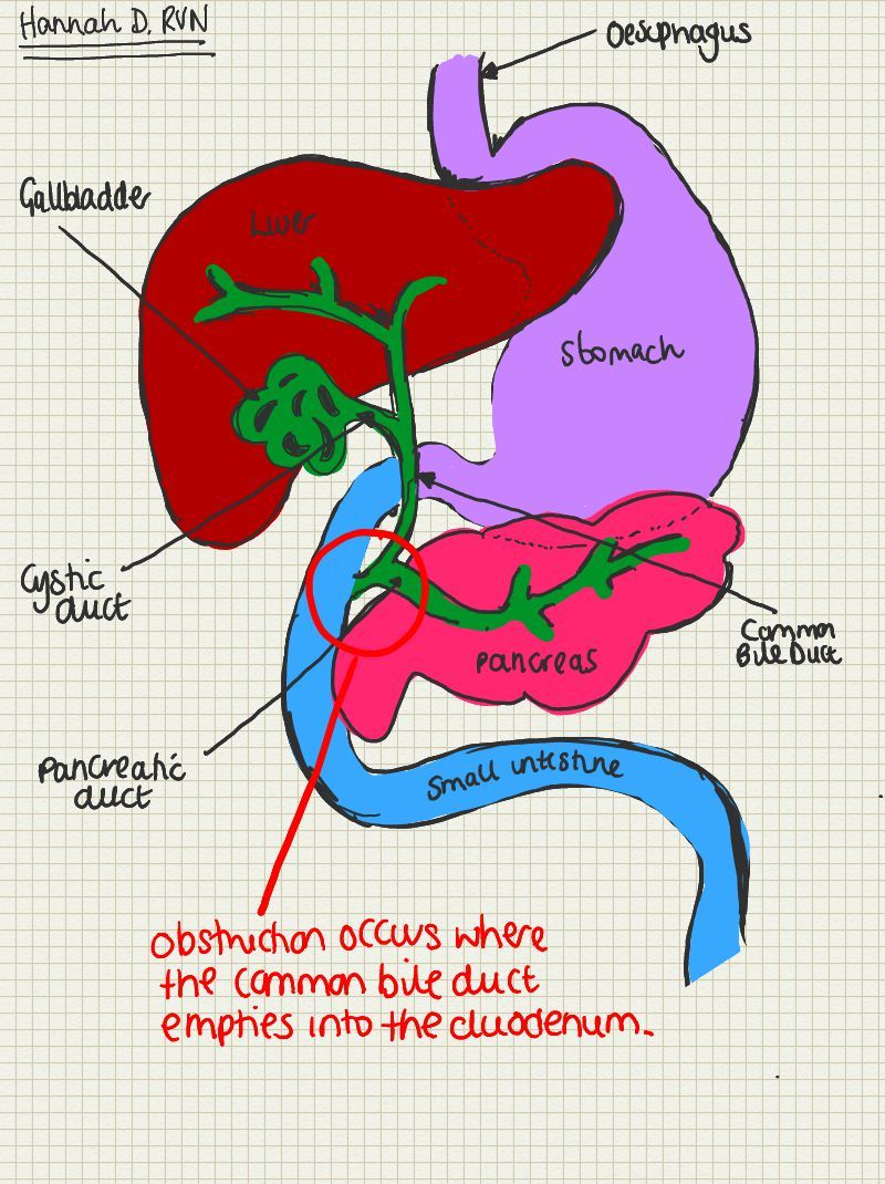 A Place To Find Hints Tips And Ask Questions Extrahepatic Biliary Tract Obstruction Ehbo