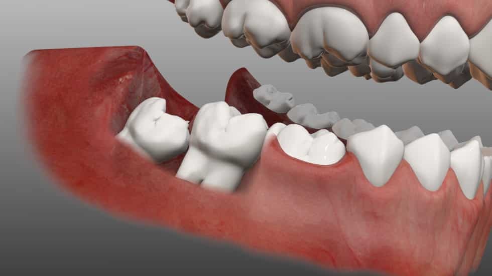 Born Without Wisdom Teeth - TeethWalls