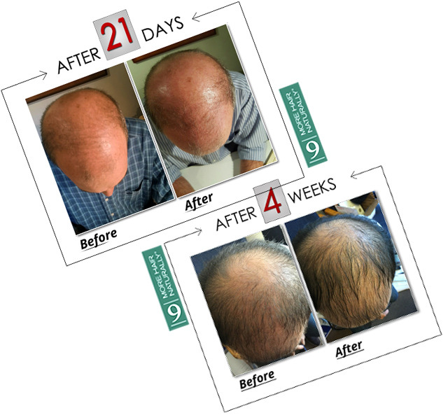 More Hair Naturally Attention Those Who Suffer From Thinning Hair