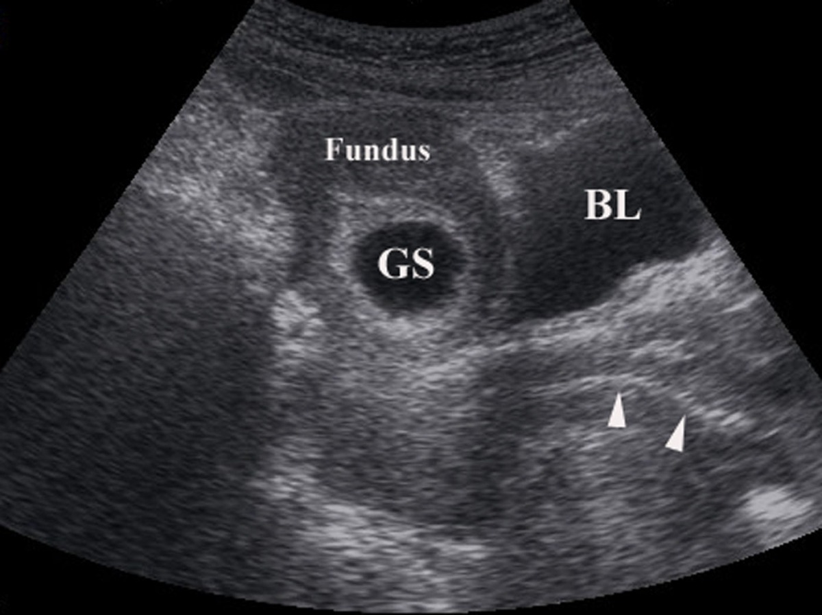 Miscellaneous (Transvaginal ultrasound of an early IUP; fetal...)