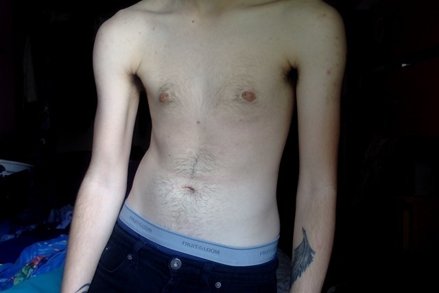 In Progress Before And After Anyone I Had Top Surgery