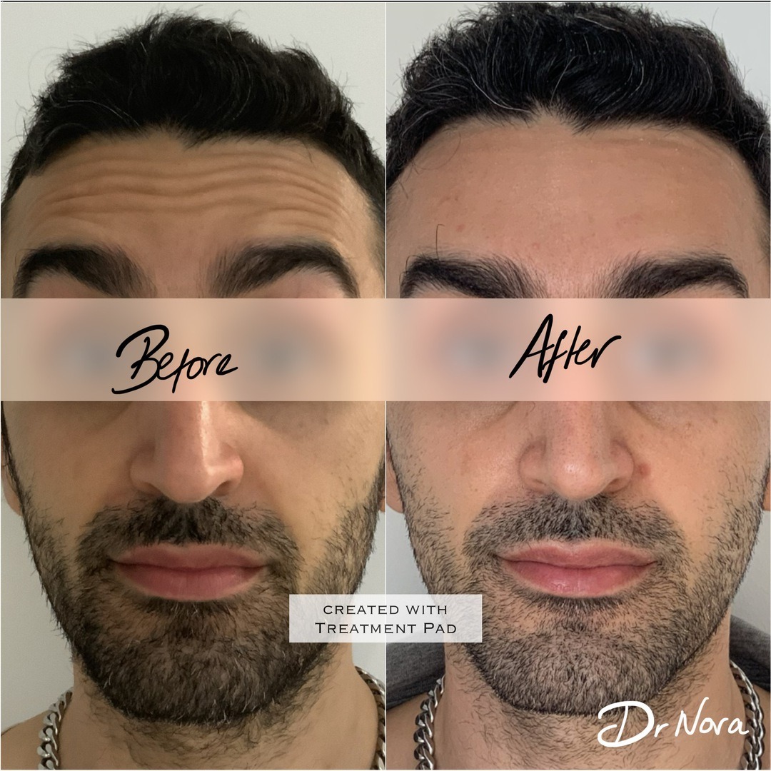 Anti-wrinkle treatment of the forehead 😲Anti-wrinkle therapy is a quick and easy way to reduce the appearance of strong and deep lines. Treatment time is 15 minutes, optimal results are seen at 2 weeks and lasts up to 3-5 months.
If you have any...