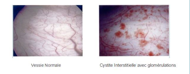 cystite interstitielle forum - cystite nerveuse symptômes