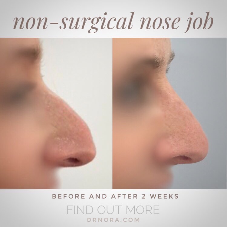 Amazing nose transformation! 👃Facial profiling is this years biggest trend in the cosmetic industry and this patient opted for changing the shape to help.
Fillers can help to reshape the nose and alter your profile. When placed correctly filler can...