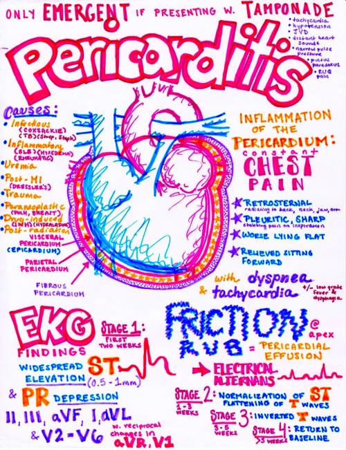 pericarditis