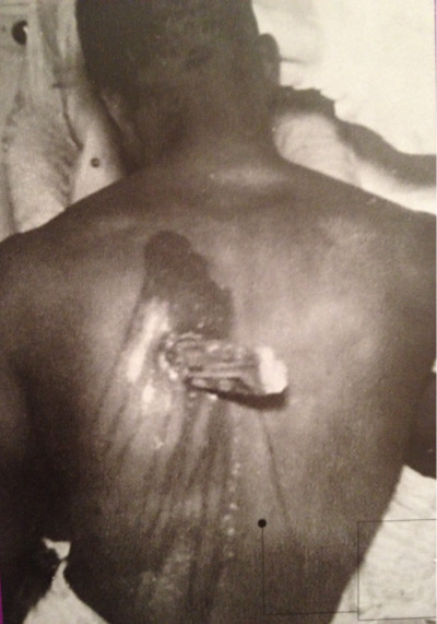 On November 17th 1941, Ivory Hill, a 28 year old plantation worker from New Orleans, survived an automobile accident in which a wooden post 27 inches in length pierced through his chest, narrowly missing his heart. Following the accident, Hill walked...