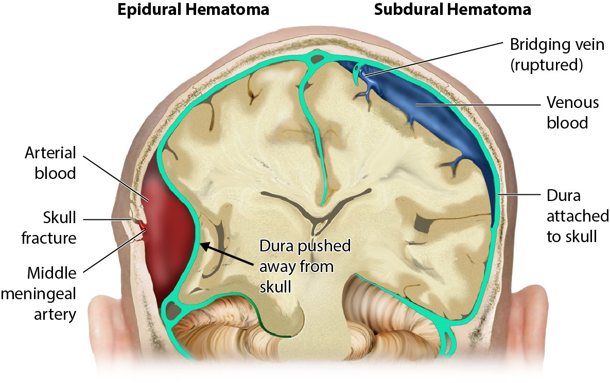 Cranial Hematoma