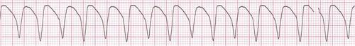 EKG rhythms for EMT Basics & Succinylcholine Chloride