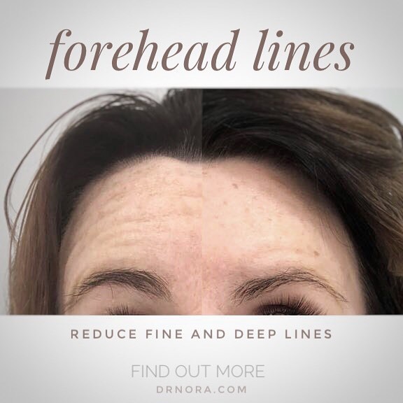 Goodbye forehead lines! πIs exactly what this beautiful lady is saying after having successful anti-wrinkle treatment across her forehead π
Anti-wrinkle therapy is quick and easy with optimal results at 2 weeks and treatment lasting 3-5 months, you...