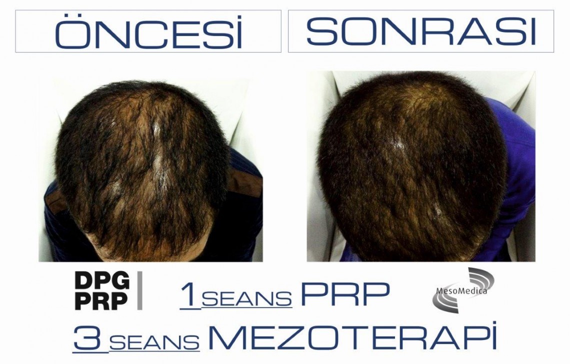 Saç Mezoterapisi Nedir-Saç Mezoterapisi Yaptıranlar Fiyatları-Saç Mezoterapisinin Faydaları Saç Mezoterapisi Nedir-Saç Mezoterapisi Yaptıranlar Fiyatları-Saç Mezoterapisinin Faydaları