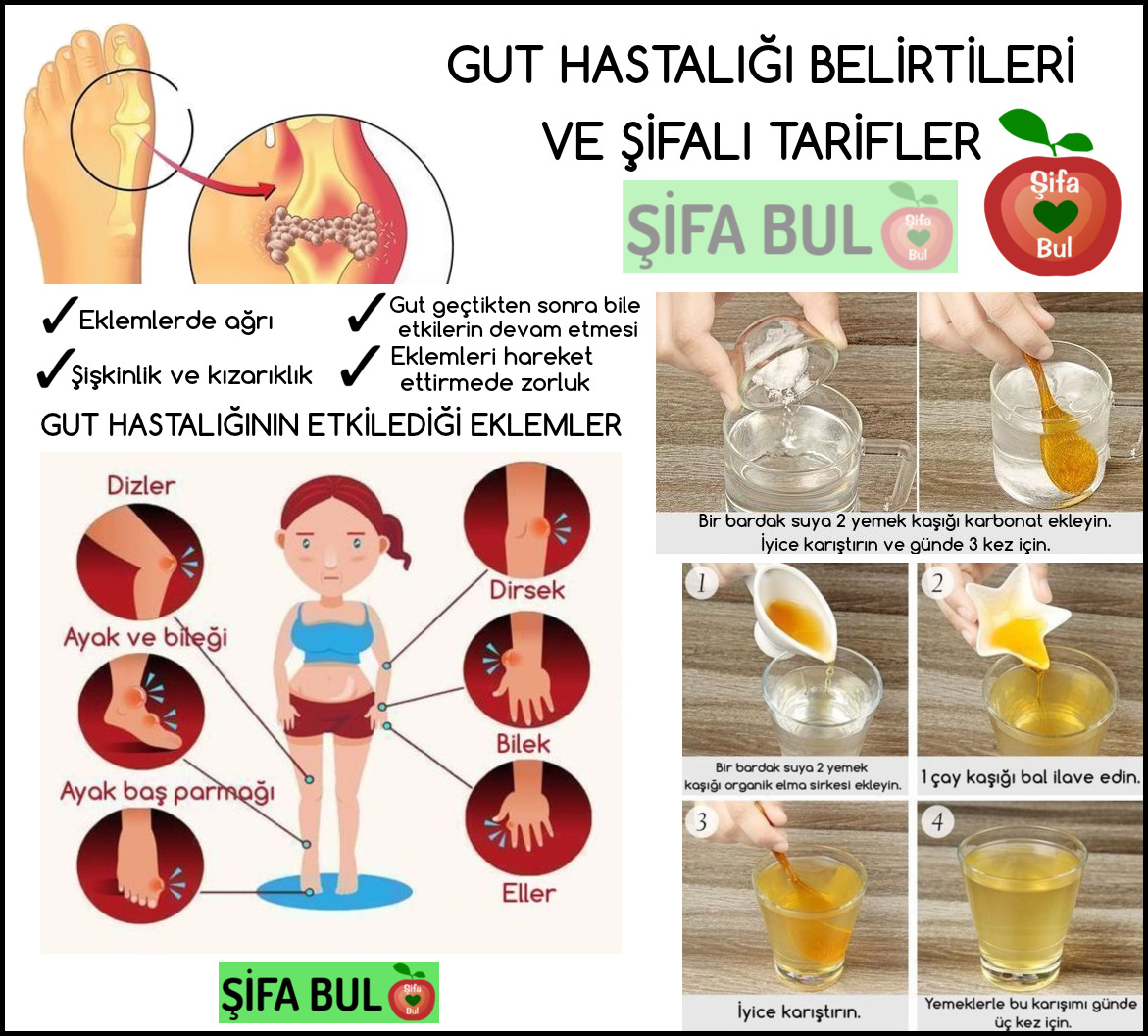 Gut Hastalığı Nedir Belirtileri ve Tedavisi Gut Hastalığı Nedir Belirtileri ve Tedavisi