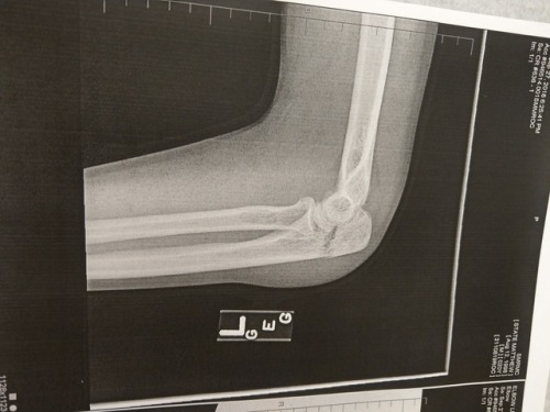 candygarnet:so yeah, this is my broken elbow. the doc said...