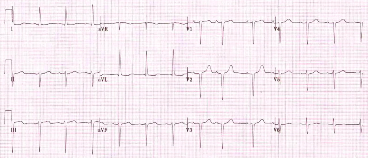 erratic-emedicine-ecg-axis-deviation-the-normal-axis-of-the-heart