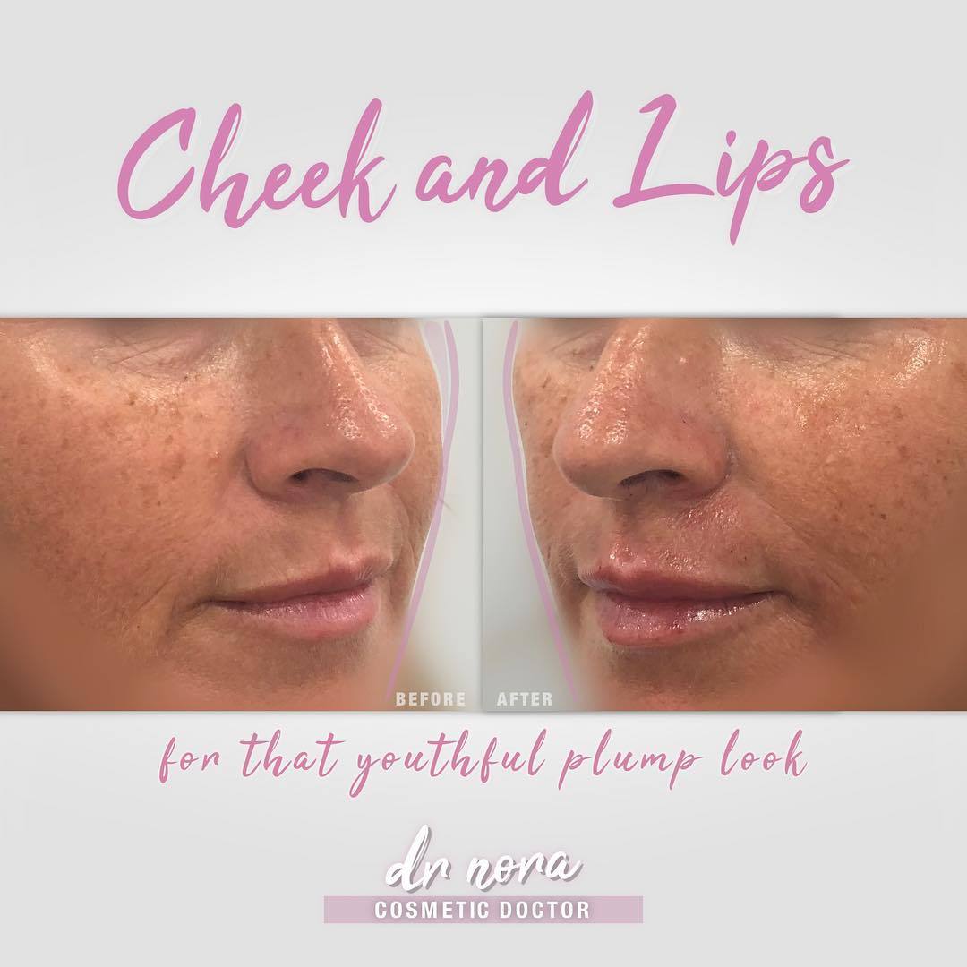 It doesn’t take much to rejuvenate your face 😍This beautiful lady had her cheeks and lips plumped up with dermal filler giving her great contouring and hydrated lips. Perfect for keeping your make up on point 👌
Cheeks fillers are expected to last up...