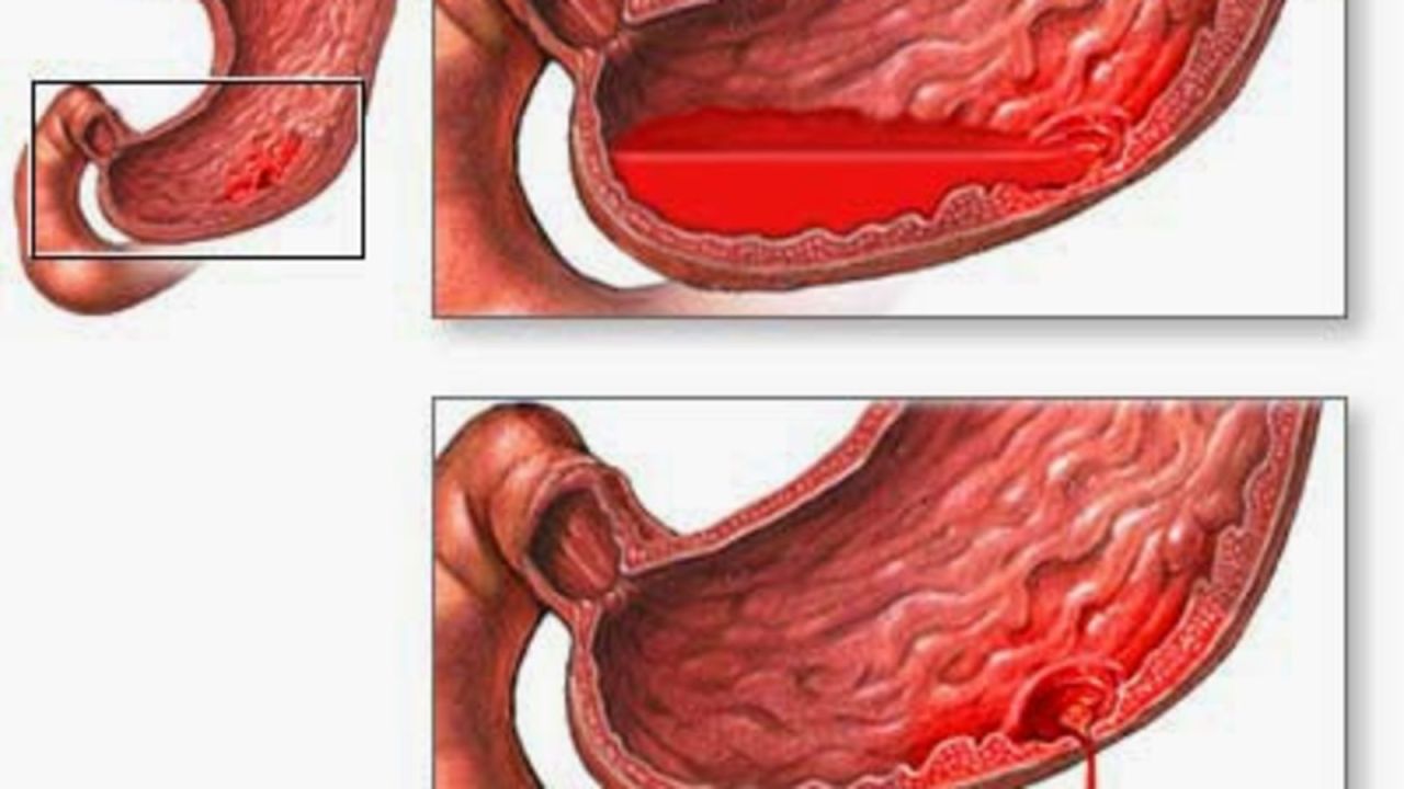 Penyebab Asam Lambung Rendah Dan 4 Cara Mengatasinya