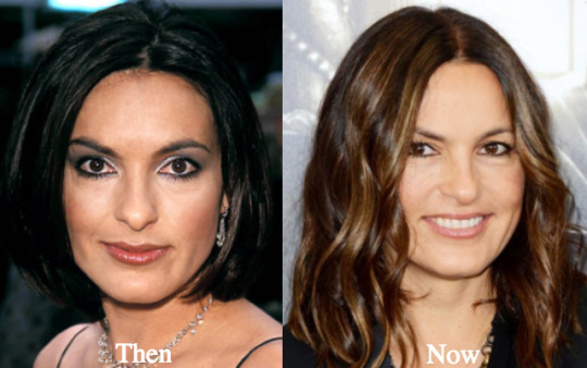 free mariska hargitay plastic surgery