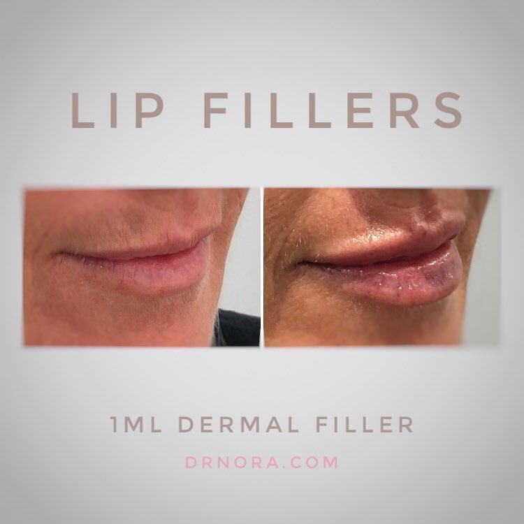 What a difference 1ml can make! ๐This beautiful lady had 1ml of dermal filler in her lips with a fantastic outcome!
Her lips are fuller, plumper and look fabulously hydrated. With results expected to last up to 6 months why not treat yourself ๐
If...