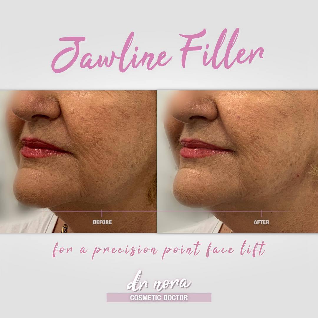 Who needs a surgical face lift when you’ve got fillers?This lovely lady has started her facial transformation journey with the aid of dermal fillers and the results are on point ๐
Here I’ve injected filler along the jaw line to bring definition back...