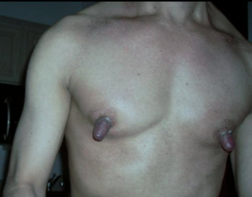 Male Nipples Enlarged 25