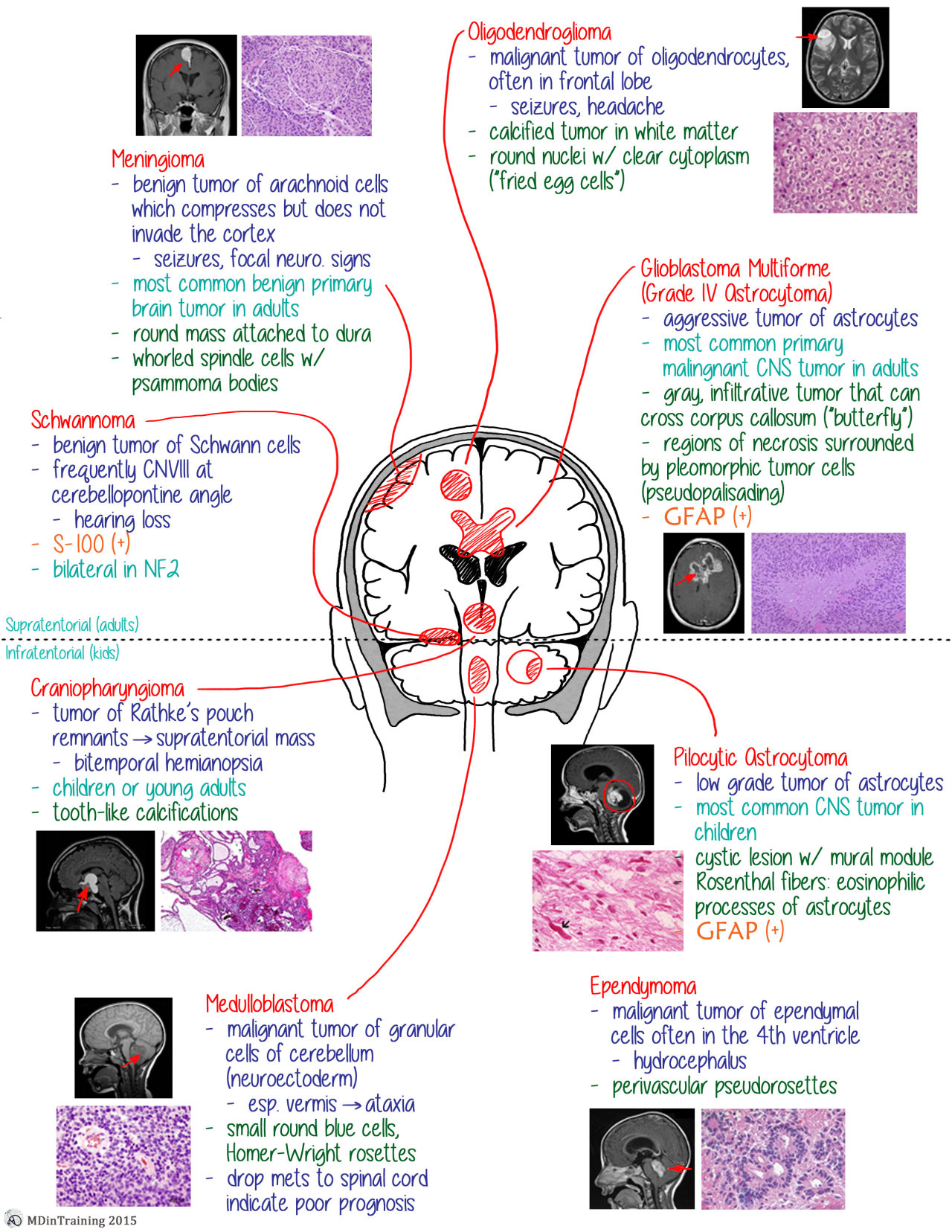 presentation for brain metastasis