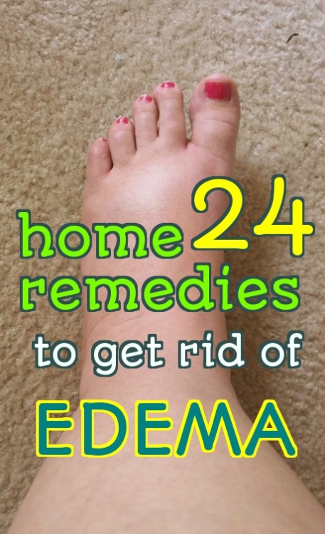 home-remedy-hacks-24-effective-home-remedies-to-treat-edema