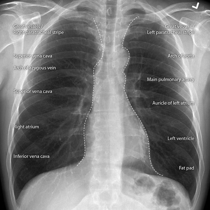 Radiology Signs • radiopaedia: Medical Imaging Anatomy Course...