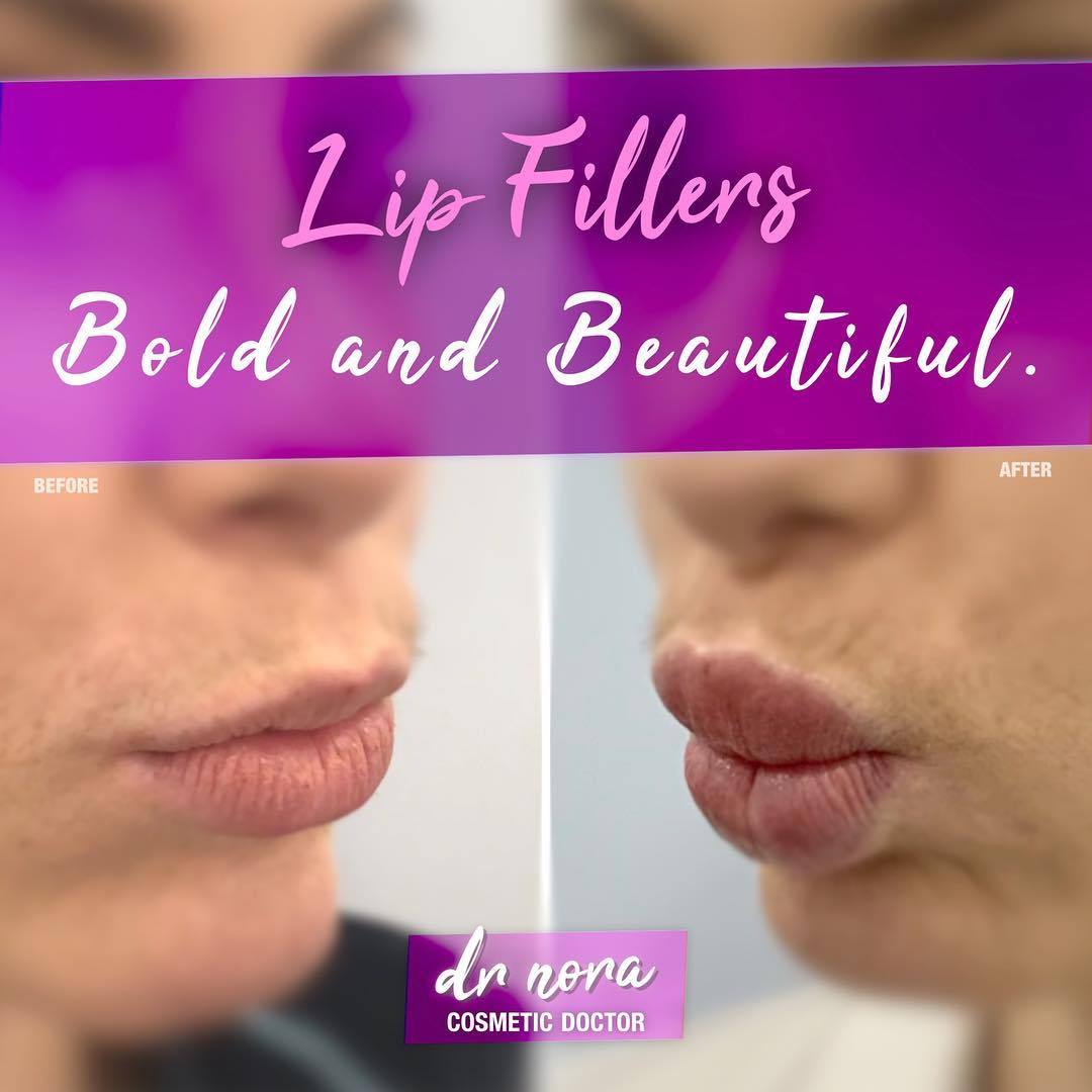 Give your lips some drama this Australia Day 💋🇦🇺 This beauty’s pout has had a dramatic makeover with two millilitres of dermal filler over consecutive treatments and the results are bold and beautiful 👄If you’re interested in finding out more please...