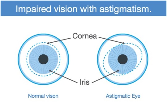 Normal vision vs Astigmatism vision