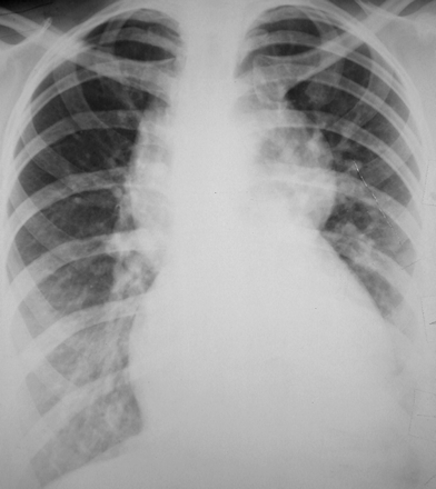 Miscellaneous (Total Anomalous Pulmonary Venous Return (TAPVR) ...)