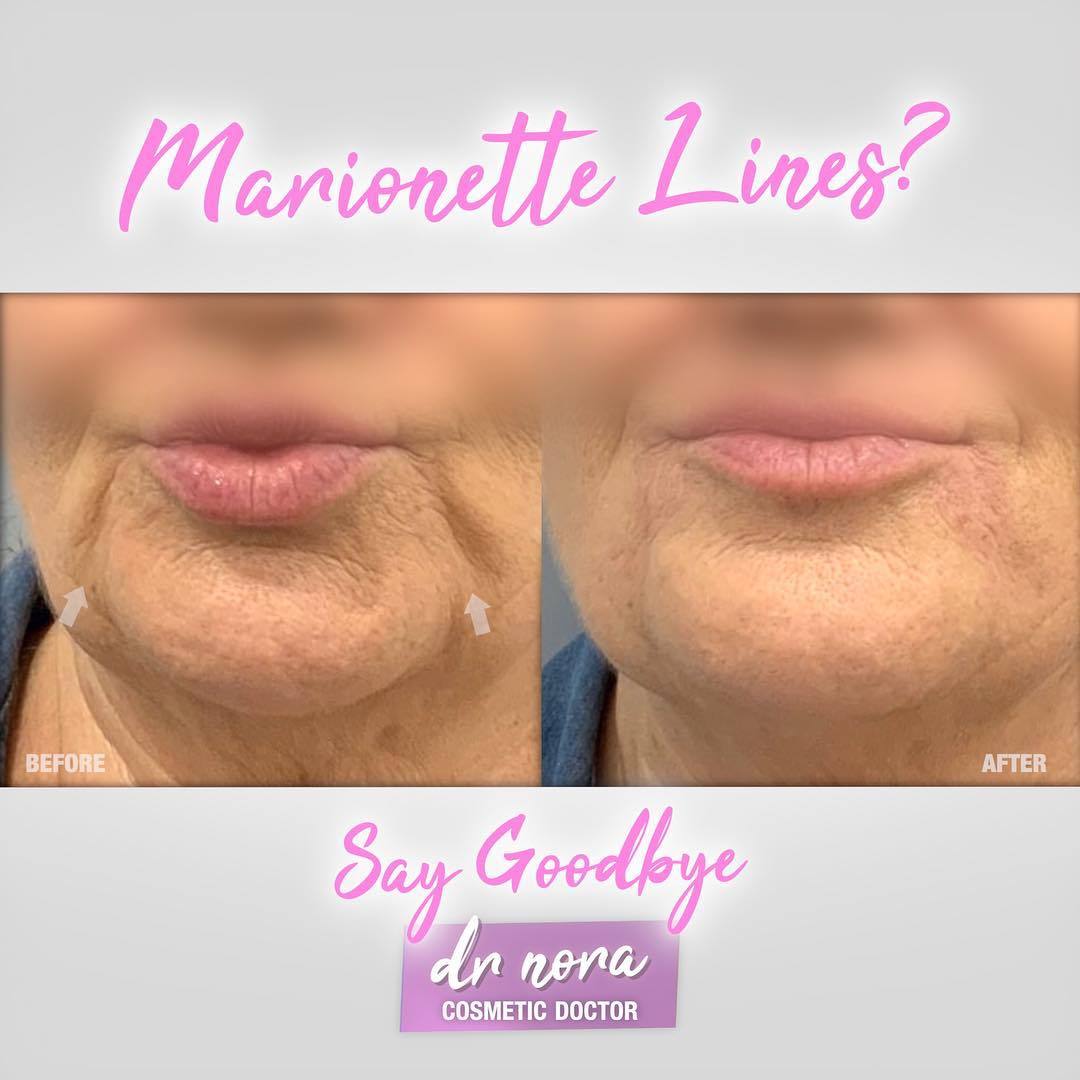 Say goodbye to marionette lines 👋As we age we lose fat from our lower face creating deep lines from the corners of the mouth to the jaw, otherwise know as marionette lines.
This patient had 1ml of strategically placed dermal filler to help reduce the...