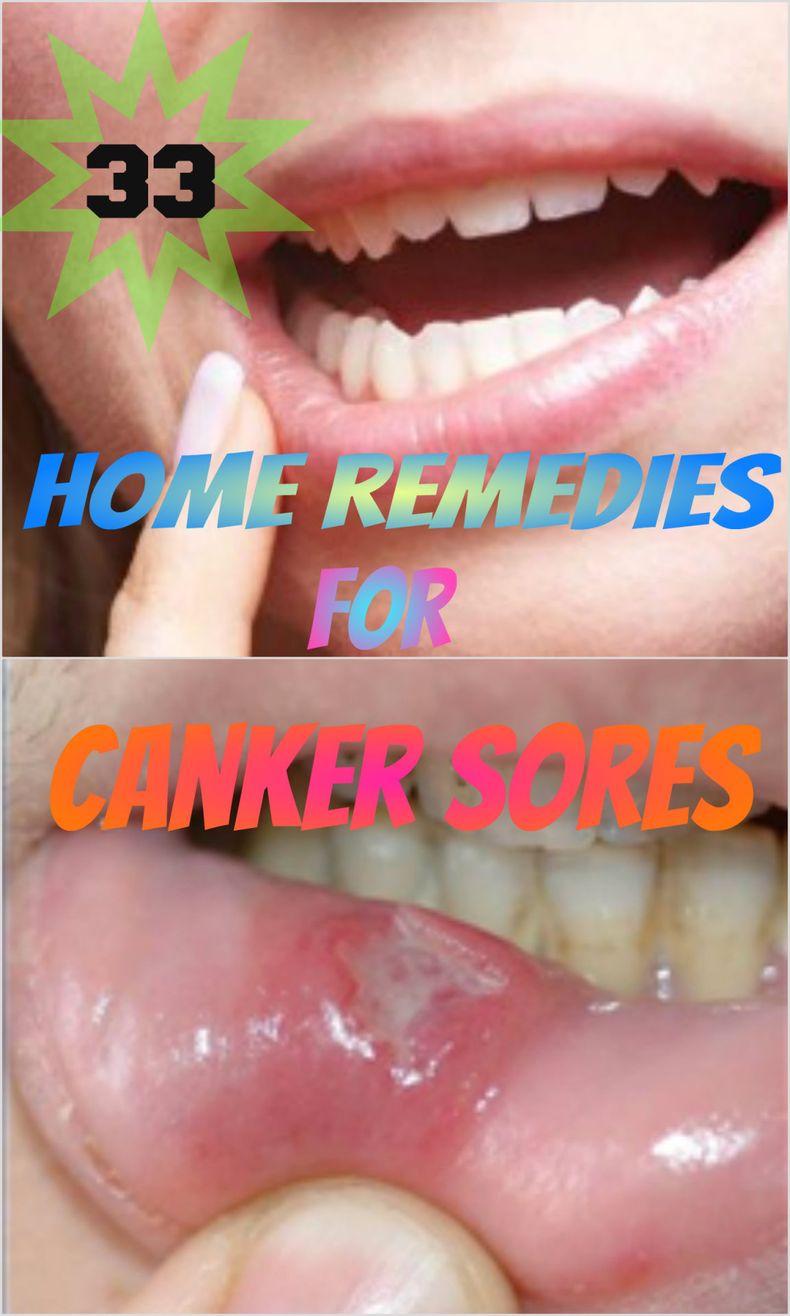 Home Remedies Store • 33 Home Remedies for Canker Sores